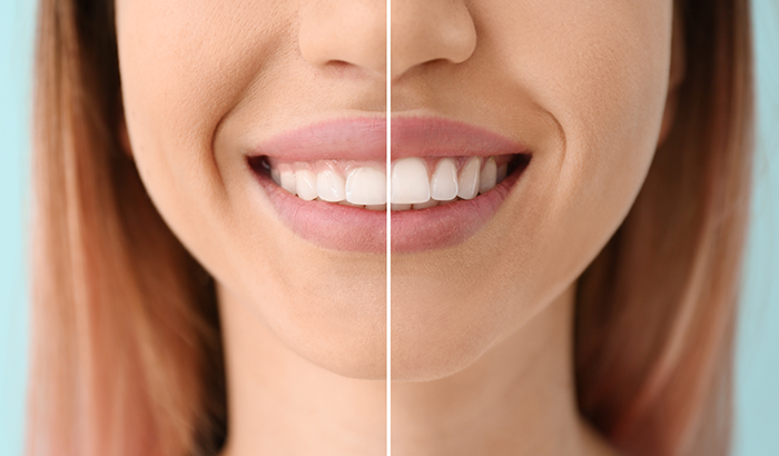 Gum Reshaping Everything You Need to Know