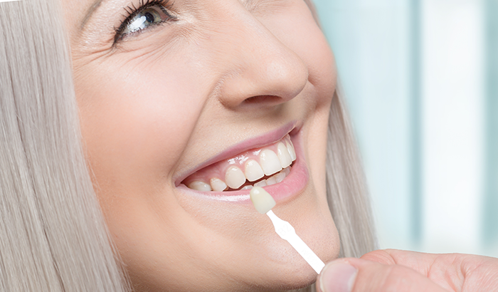 How Long Do Dental Veneers Last on Average