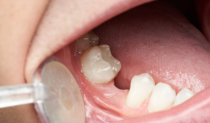 Why Its Important to Replace a Missing Tooth Even If Its Not Noticeable