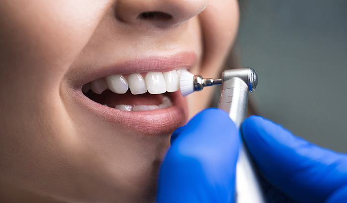 Why Professional Teeth Whitening Is the Way to Go