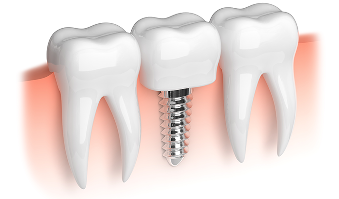 Why You Should Consider Dental Implants in